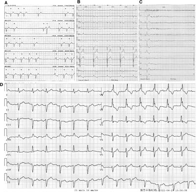 Case Report: Left bundle branch pacing in an amyloid light-chain cardiac amyloidosis patient with atrioventricular block